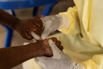 mãos com erupções da mpox